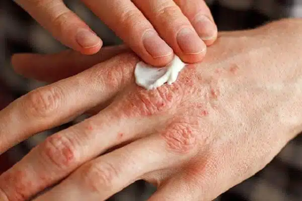 Comment soigner rapidement le psoriasis ?