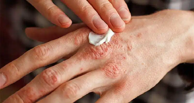 Comment soigner rapidement le psoriasis ?